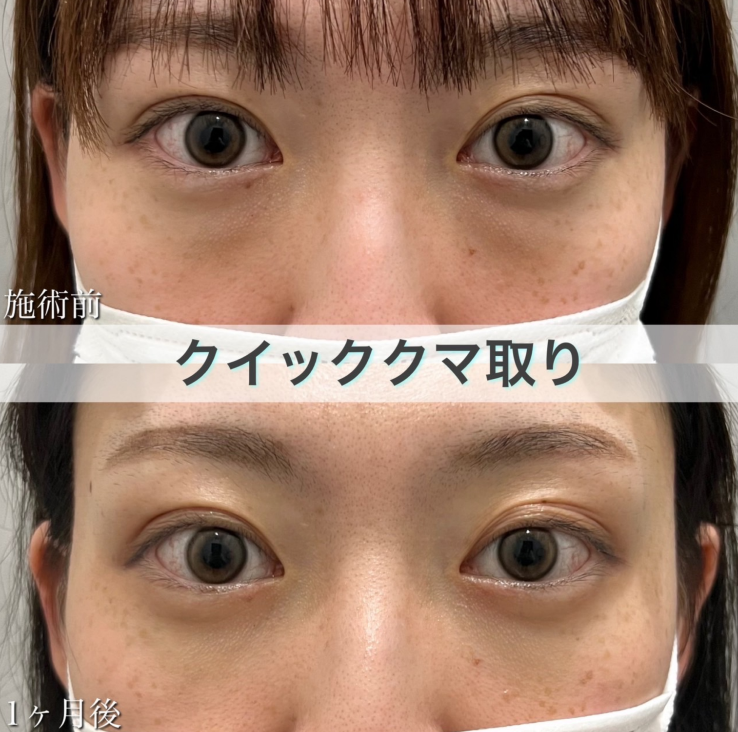 ダウンタイムを短くします