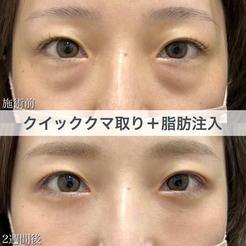 クイッククマ取り（目の下のふくらみ取り）・脂肪注入