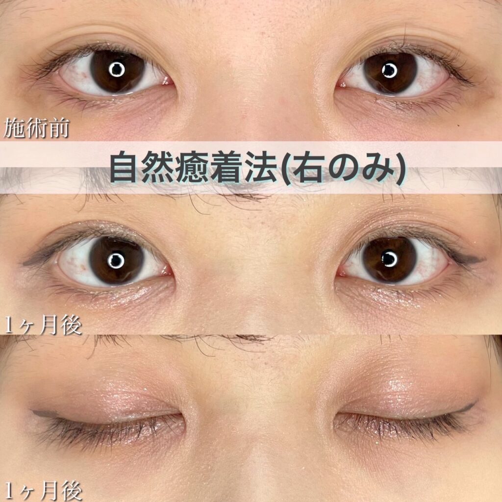 二重埋没法　自然癒着法の症例