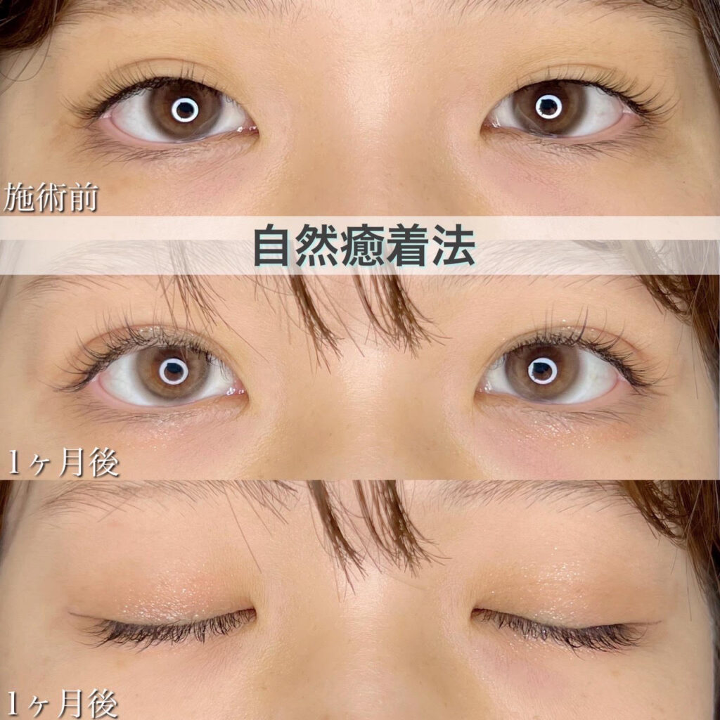 二重埋没法　自然癒着法の症例