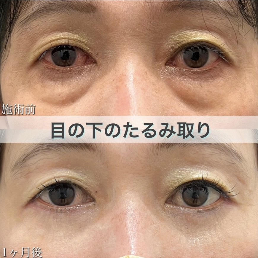 目の下のたるみ取り(脂肪除去併用)の症例