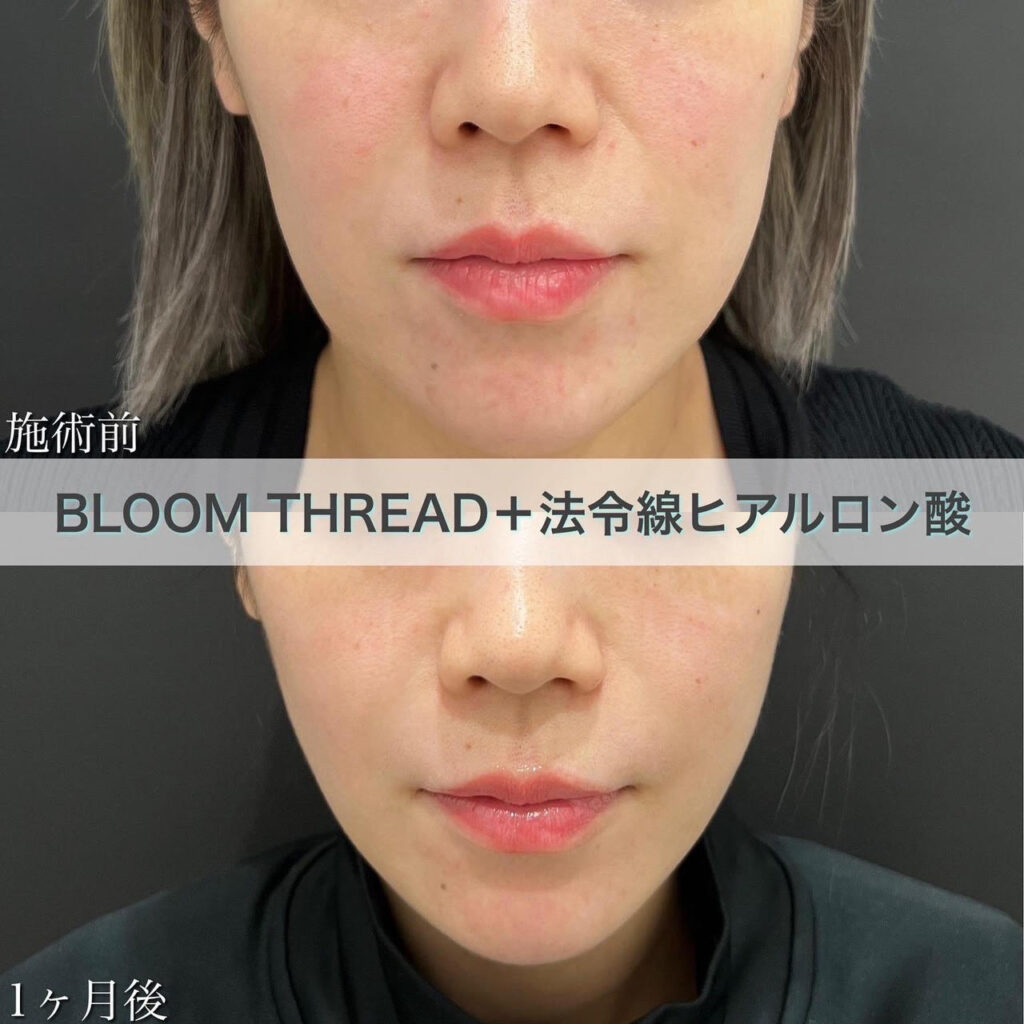BLOOM　THREAD（糸リフト）・ヒアルロン酸（ほうれい線）の症例