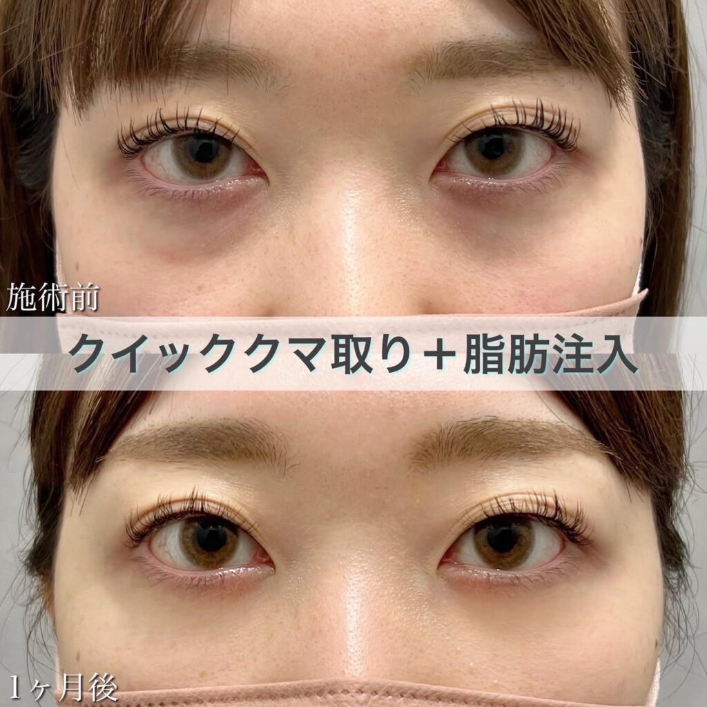 クマ取り＋脂肪注入の症例
