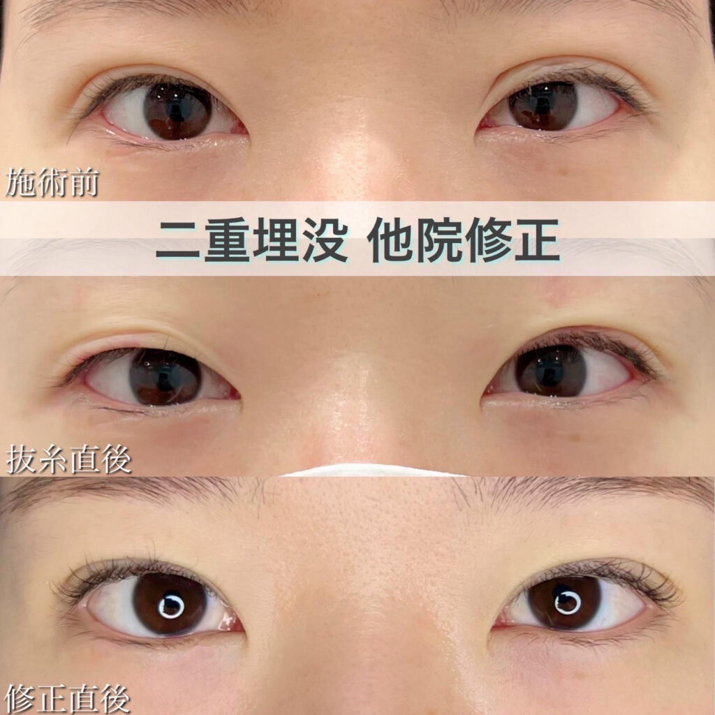 二重埋没法　自然癒着法（他院修正）の症例