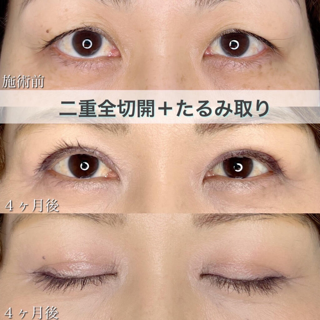 二重全切開・まぶたのたるみ取りの症例