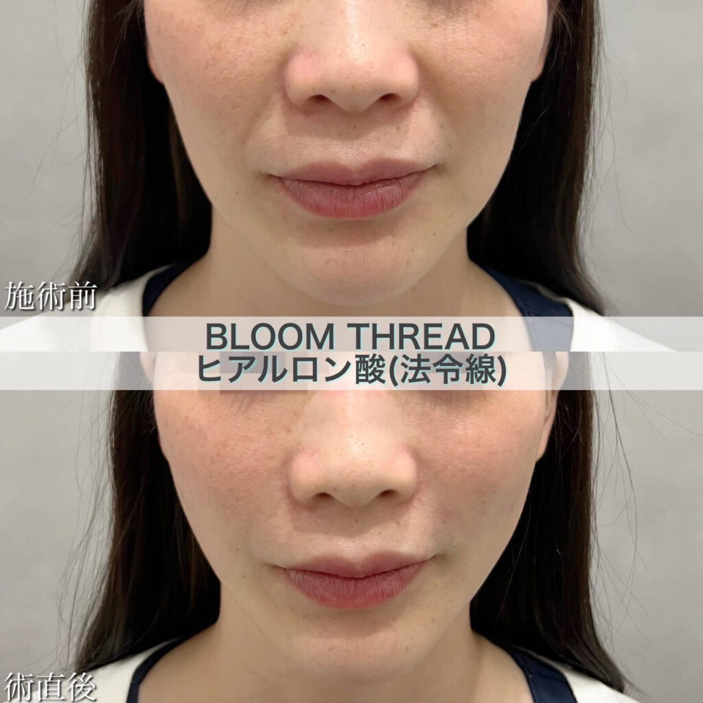 BLOOM　THREAD（糸リフト）・ヒアルロン酸（ほうれい線）の症例