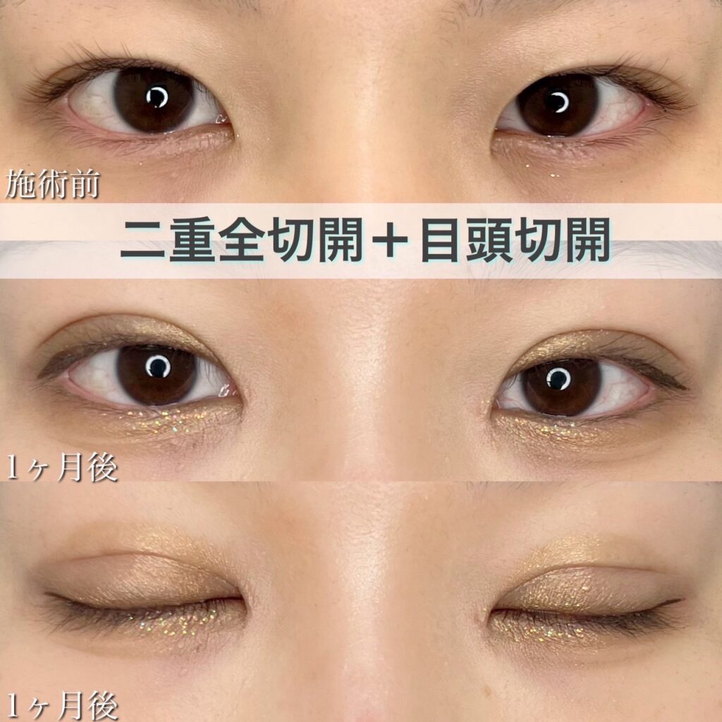 二重全切開＋目頭切開