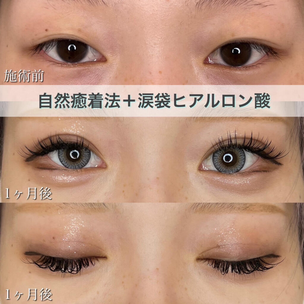 二重埋没法　自然癒着法・ヒアルロン酸(涙袋)の症例
