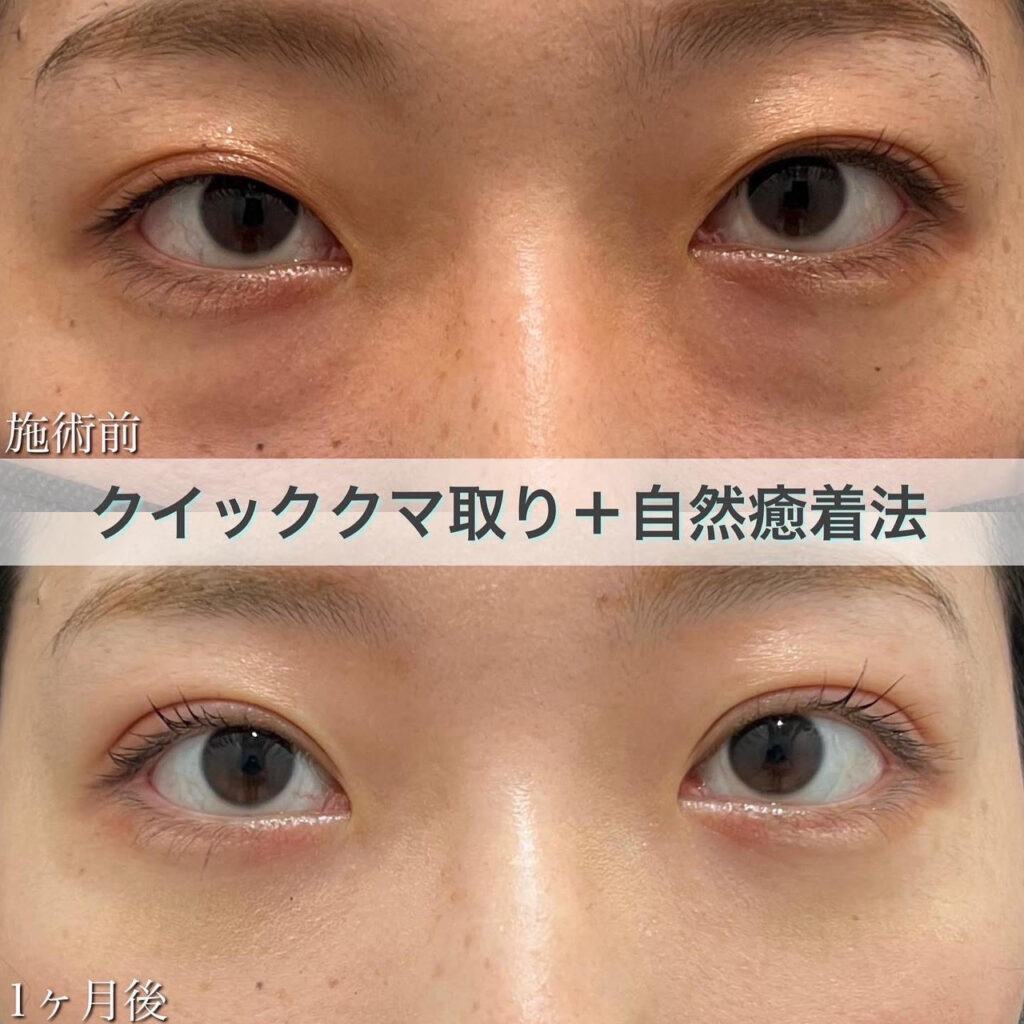 クマ取り（目の下の脂肪取り）・二重埋没（自然癒着法）の症例