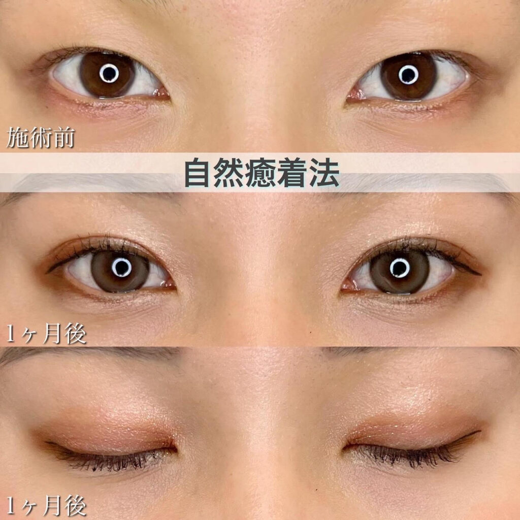 二重埋没法　自然癒着法の症例