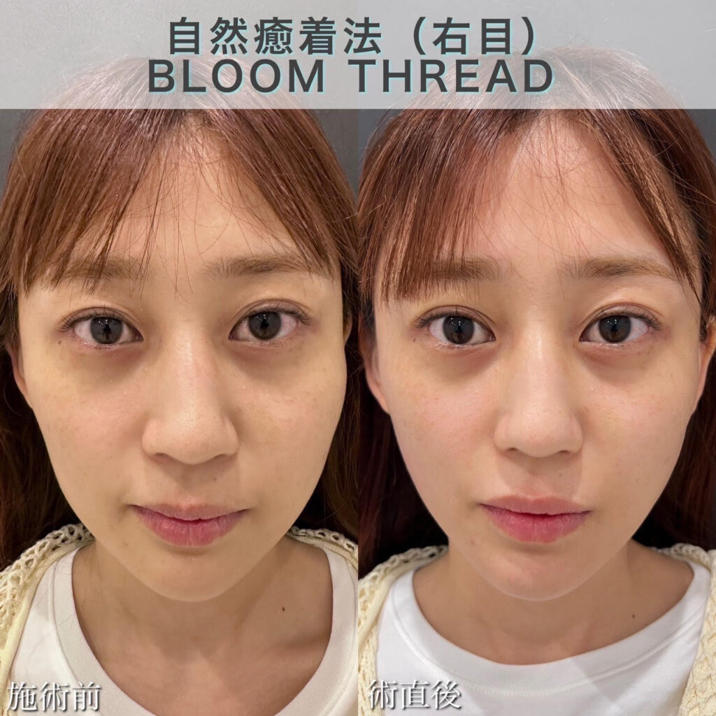 自然癒着法（右目）BLOOM THREAD