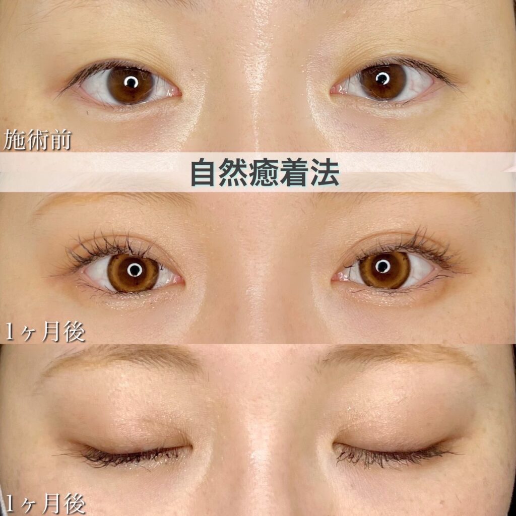 二重埋没法　自然癒着法の症例