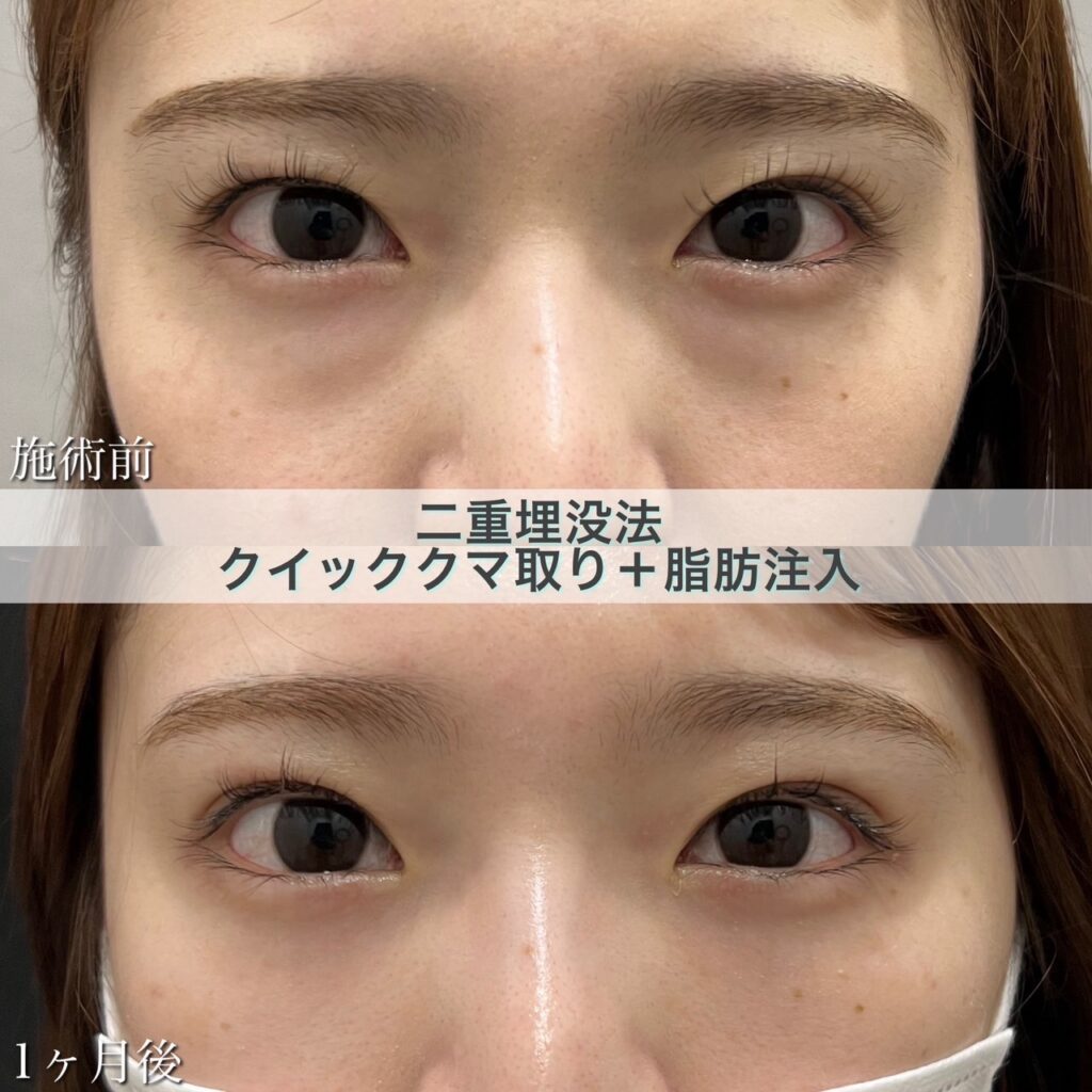二重埋没法＋クイッククマ取り＋脂肪注入