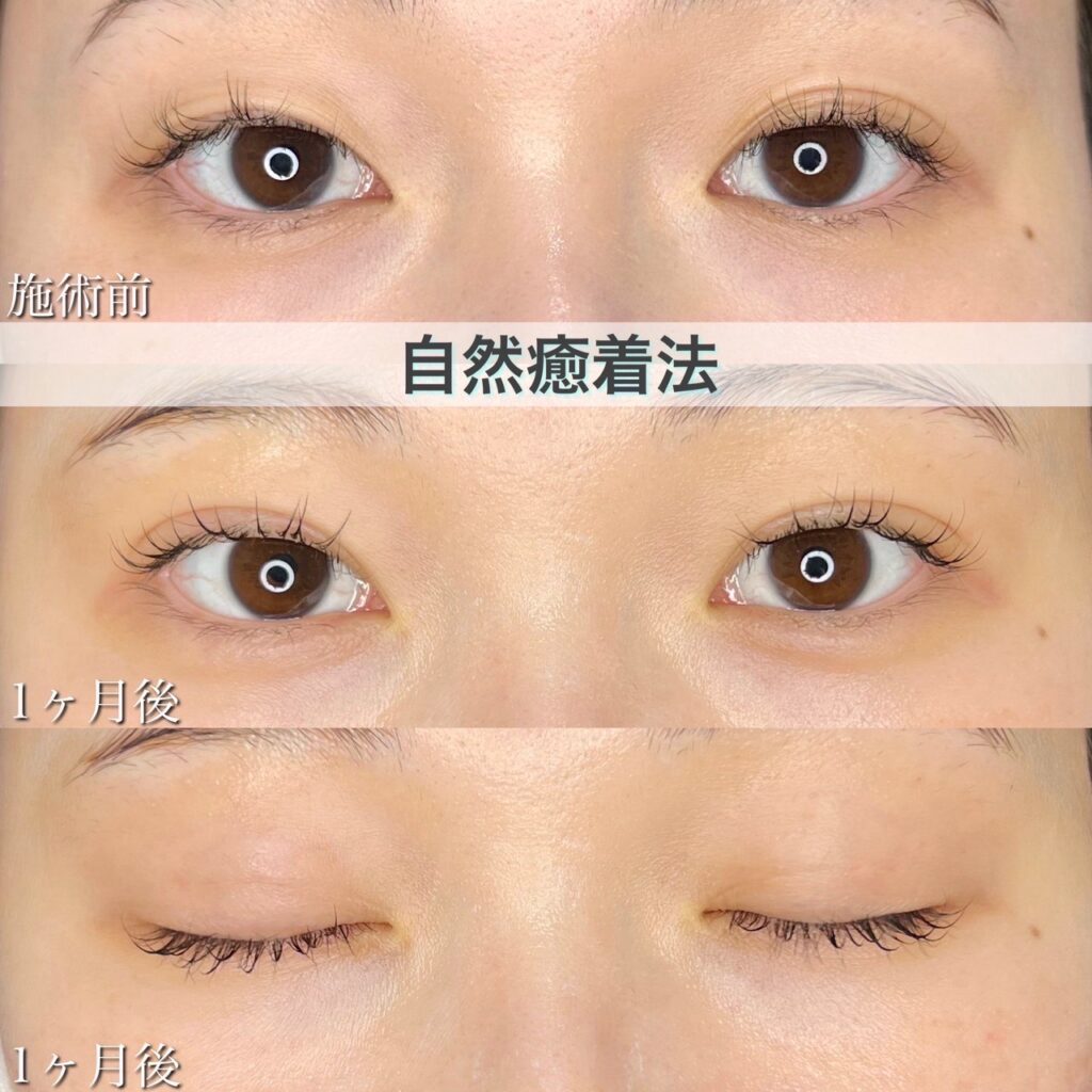 二重埋没法　自然癒着法の症例
