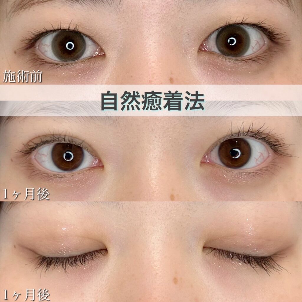 二重埋没法　自然癒着法の症例