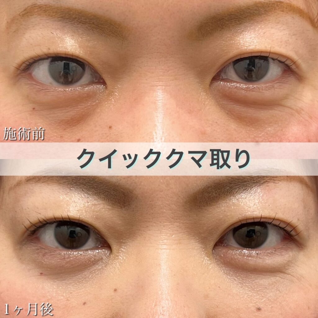 クマ取り（目の下の脂肪取り）の症例