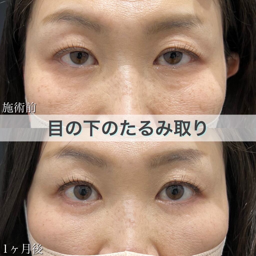 目の下のたるみ取り(脂肪除去併用)の症例