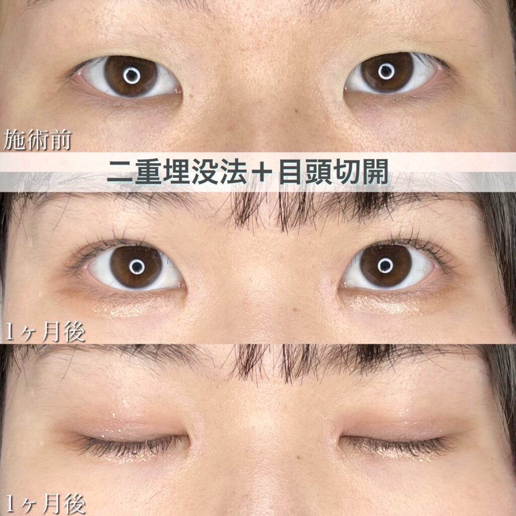 二重埋没法　自然癒着法・目頭切開の症例