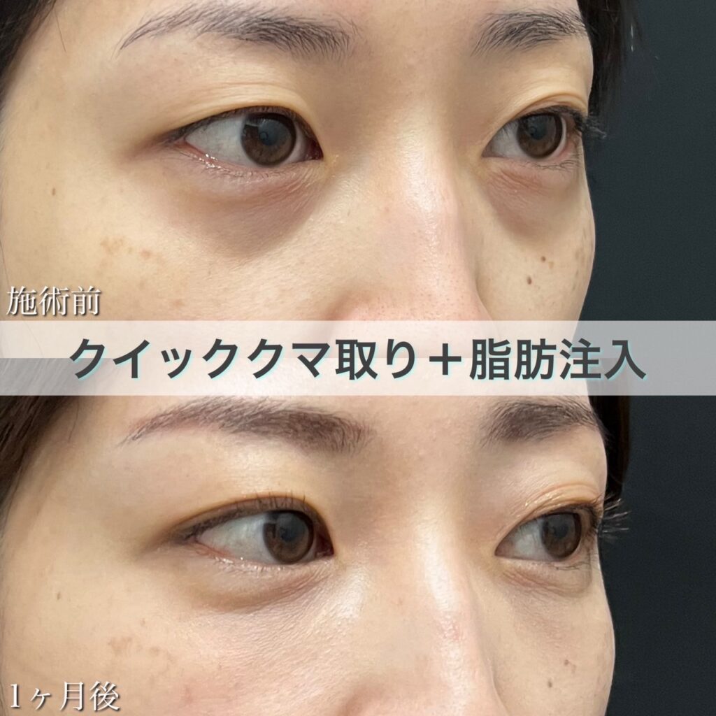 クマ取り＋脂肪注入の症例