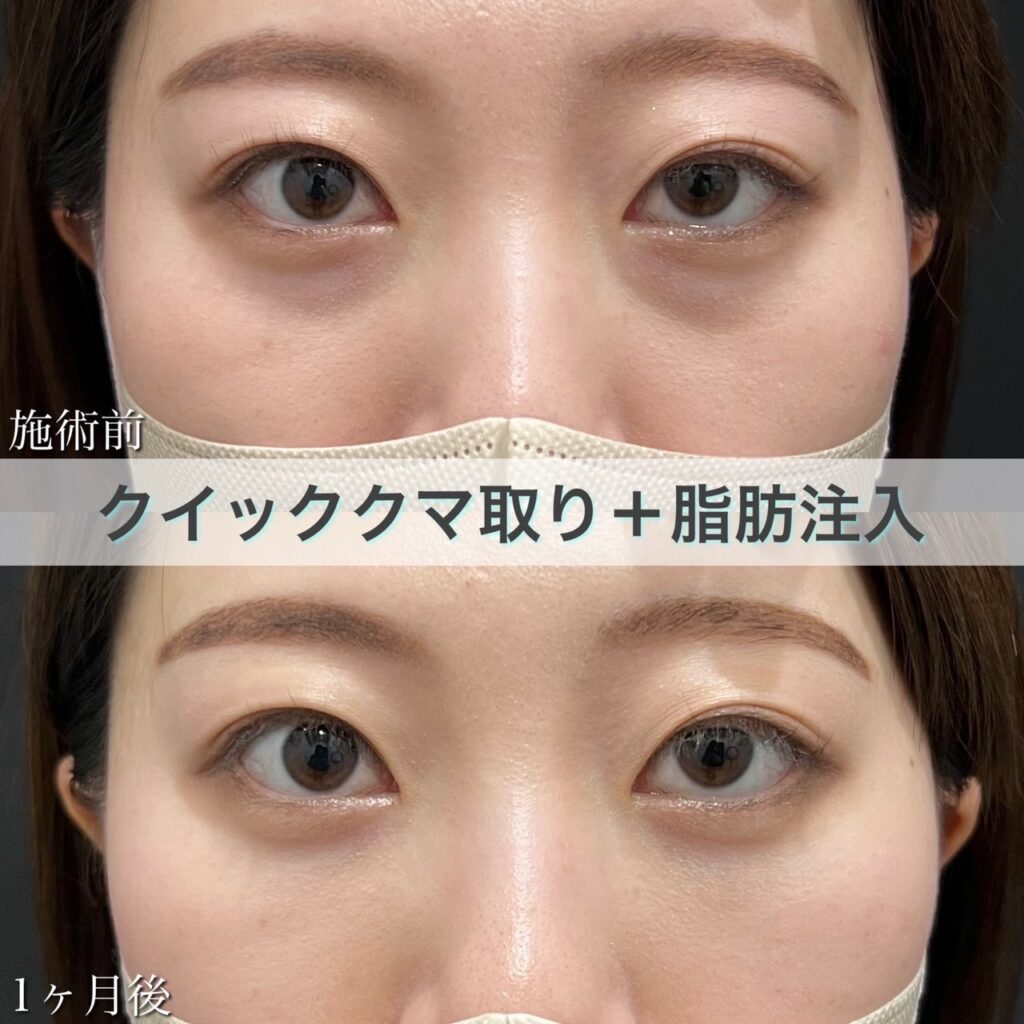 クマ取り＋脂肪注入の症例