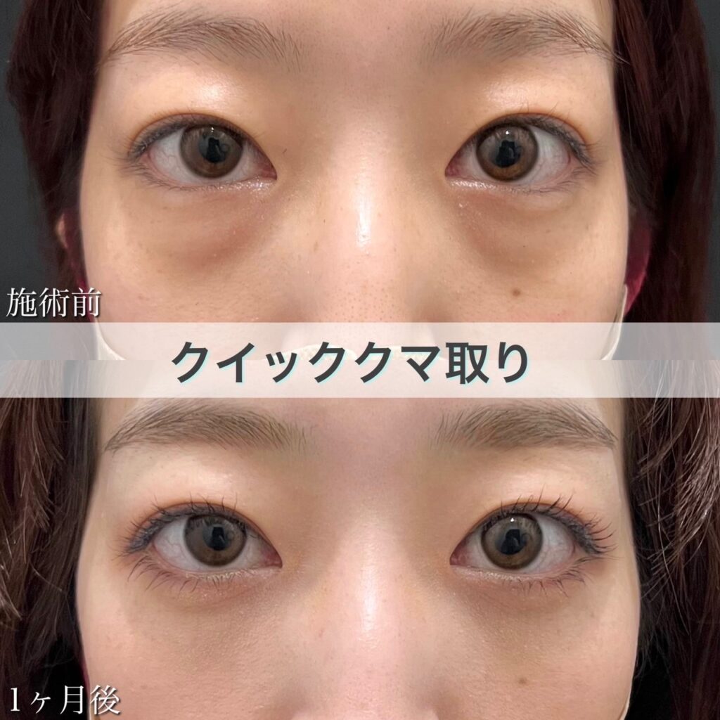 クマ取り（目の下の脂肪取り）の症例