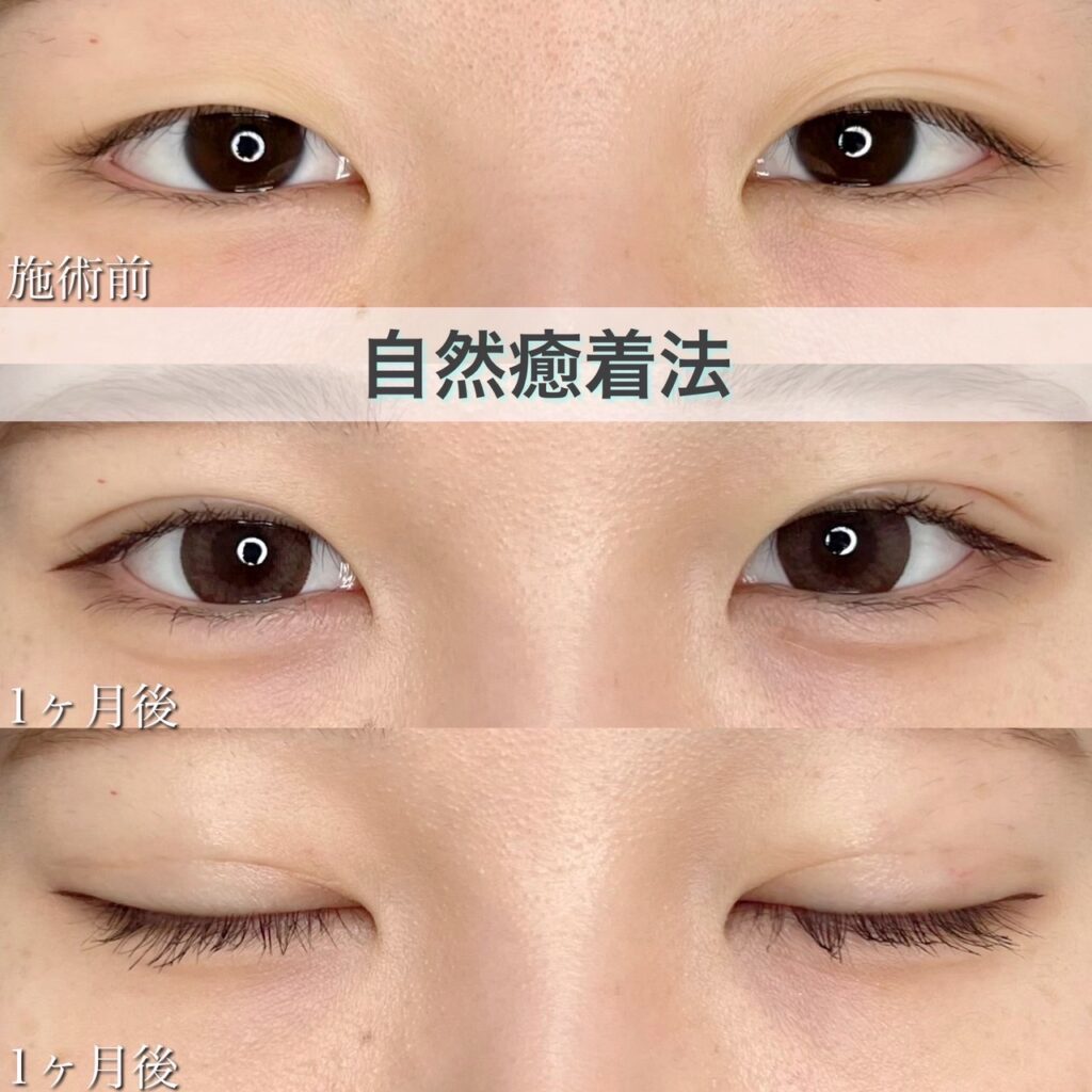 二重埋没法　自然癒着法の症例