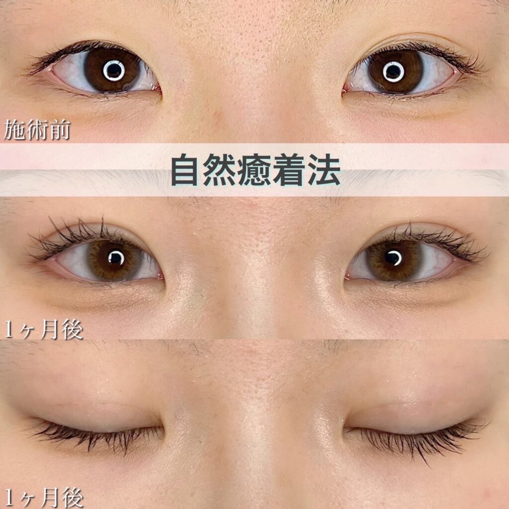 二重埋没法　自然癒着法の症例