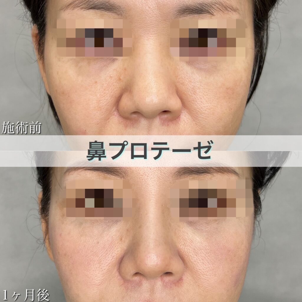 隆鼻術（プロテーゼ）
