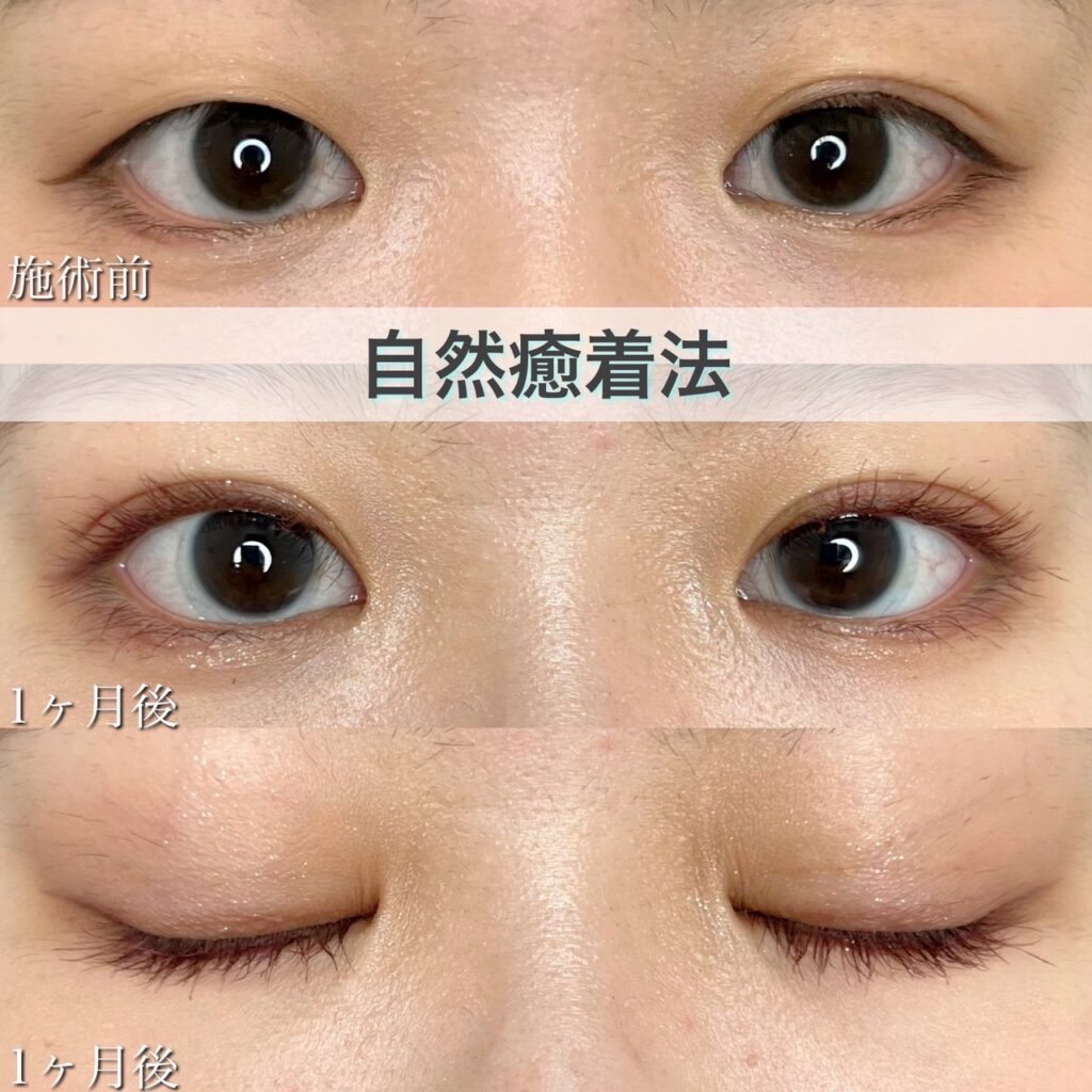 二重埋没法　自然癒着法の症例