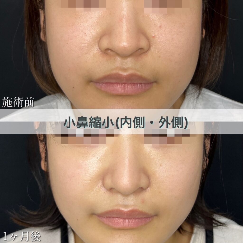 小鼻縮小切開法