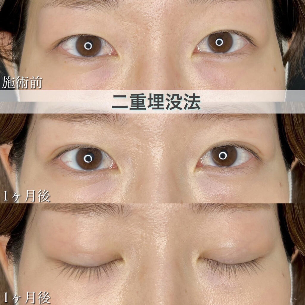 二重埋没法　自然癒着法の症例