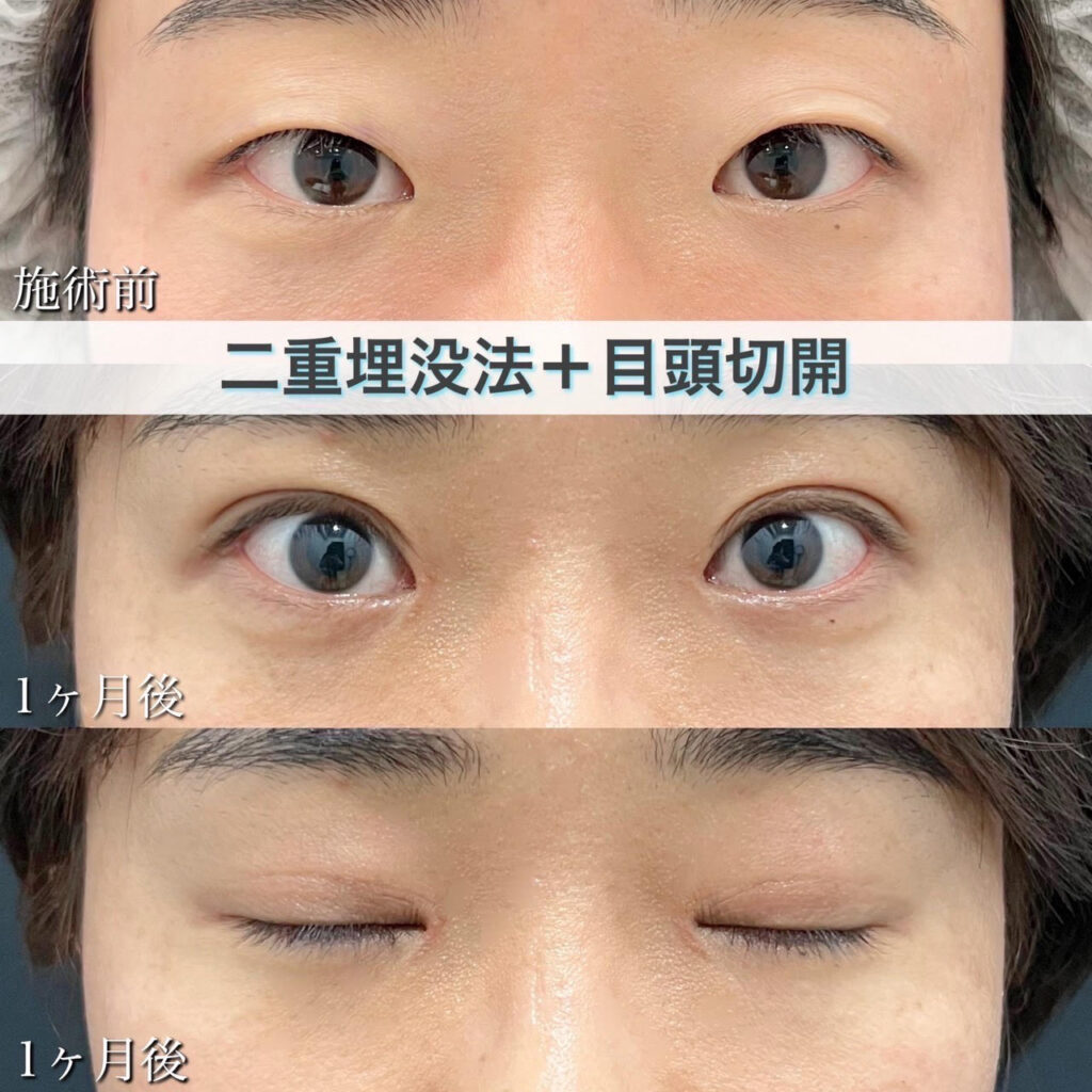 二重埋没法　自然癒着法・目頭切開の症例