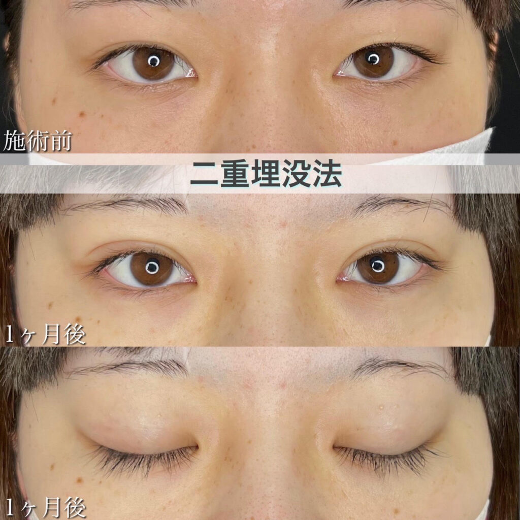 二重埋没法　自然癒着法の症例