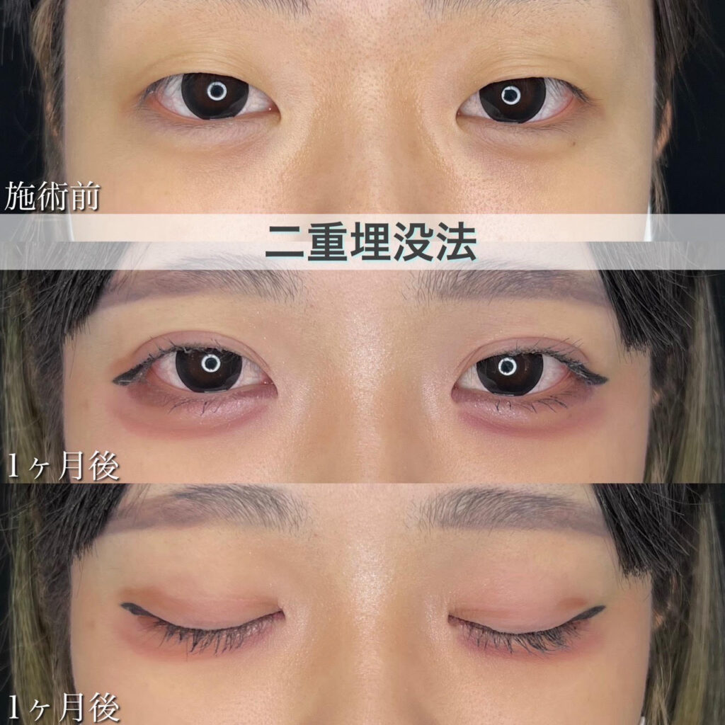 二重埋没法　自然癒着法の症例