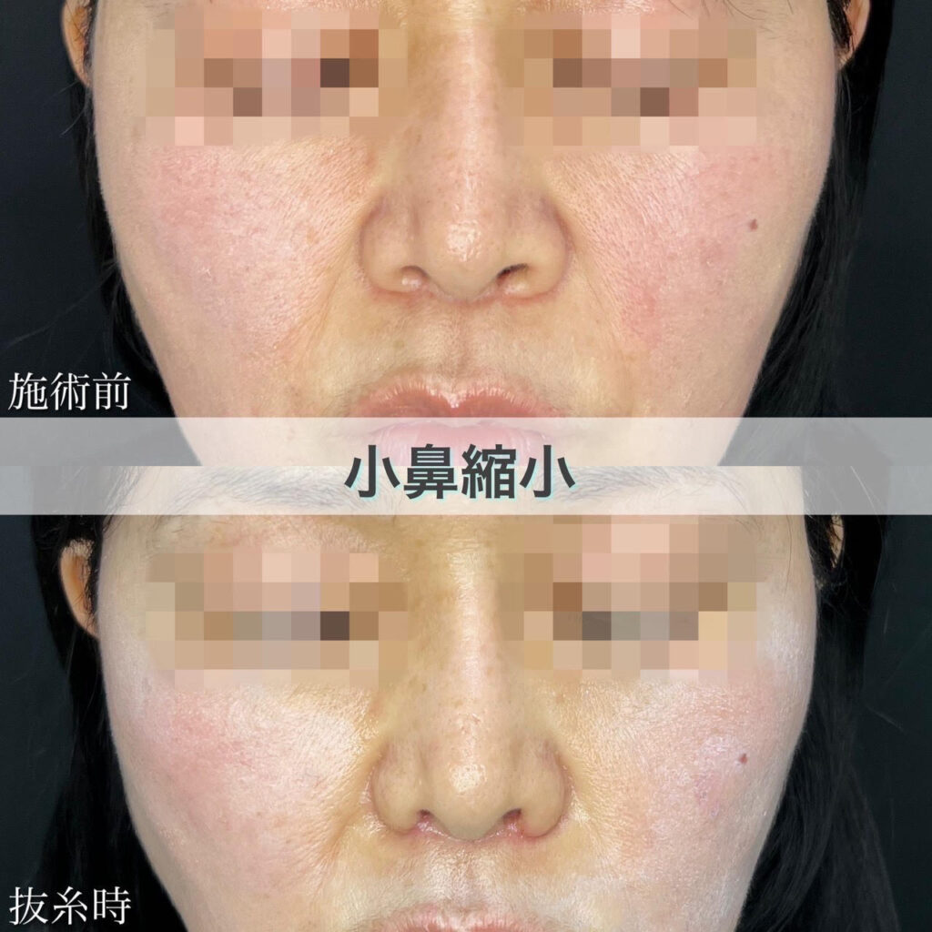 小鼻縮小切開法の症例