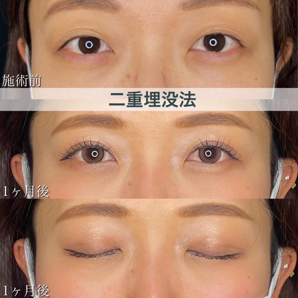 二重埋没法　自然癒着法の症例