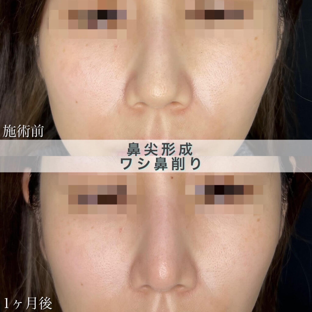 鼻尖形成・ワシ鼻修正の症例