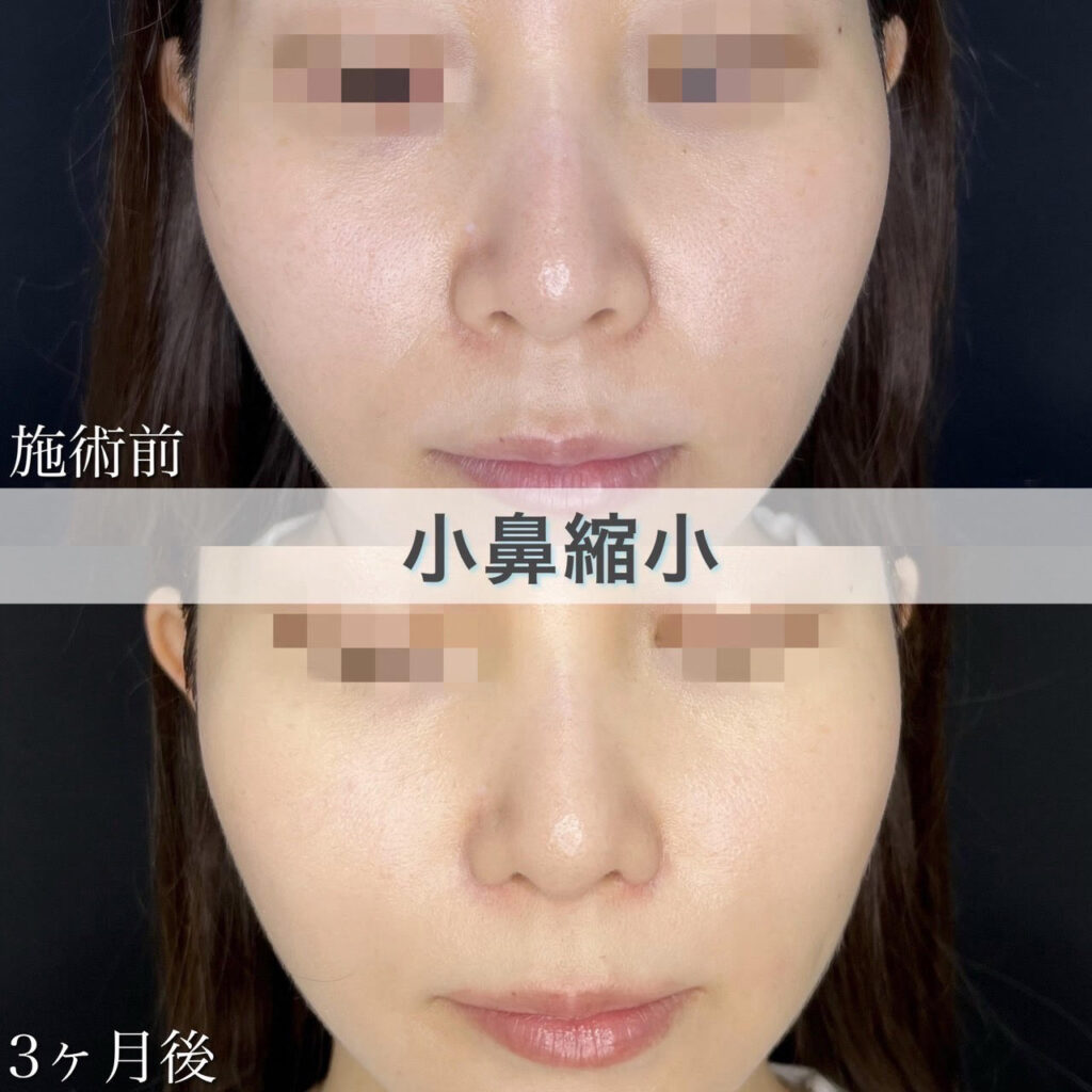 小鼻縮小切開法