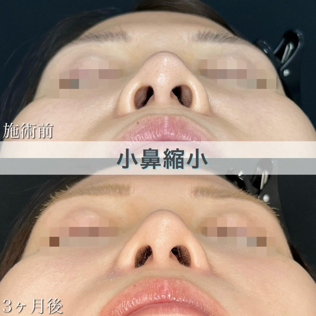 小鼻縮小切開法