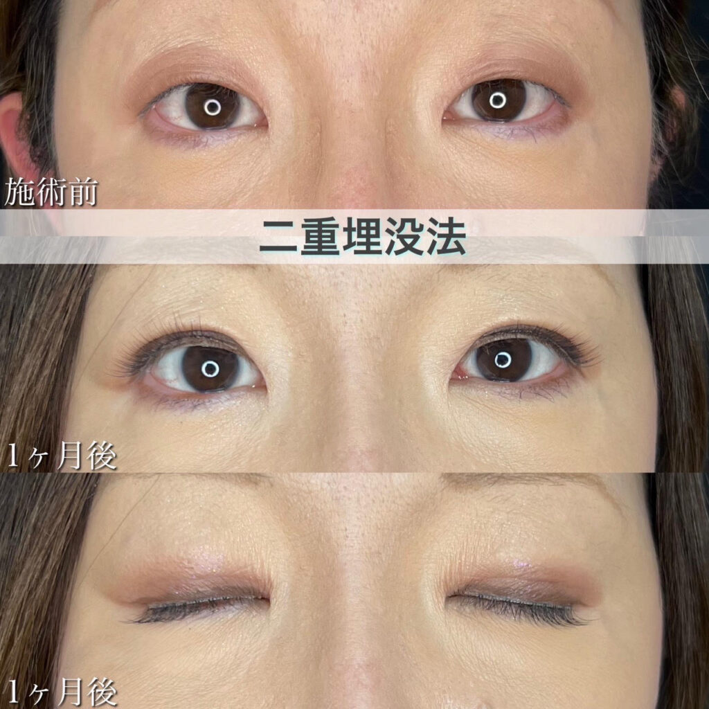 二重埋没法　自然癒着法の症例