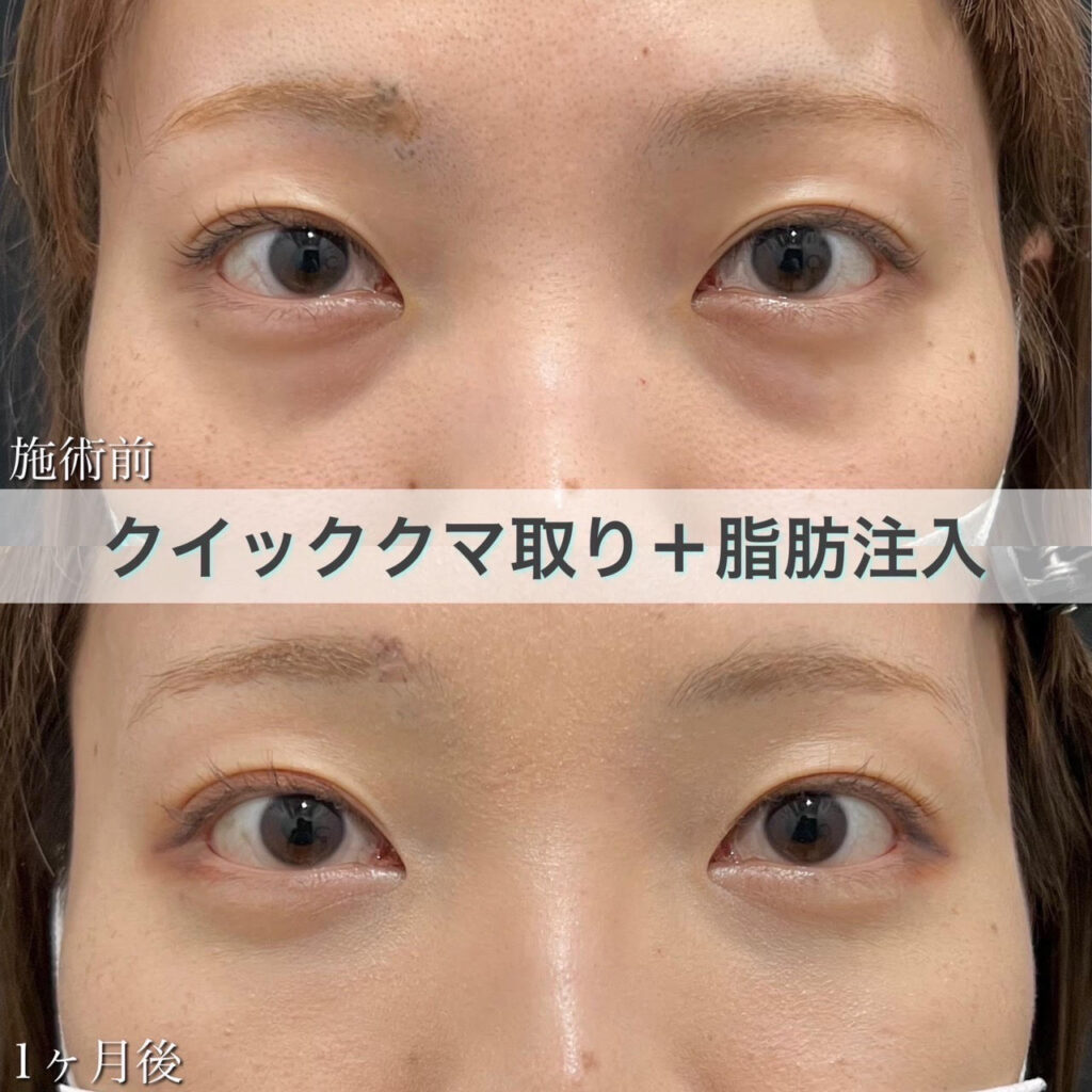クイッククマ取り＋脂肪注入