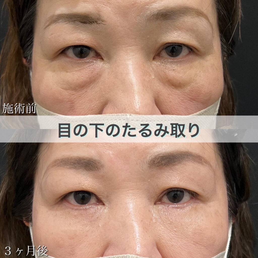 目の下のたるみ取り
