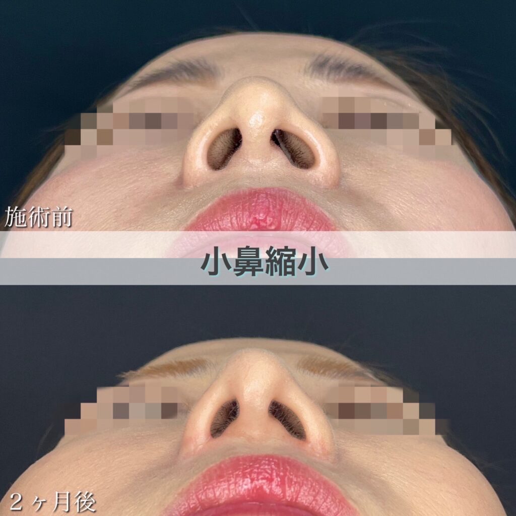 小鼻縮小切開法の症例