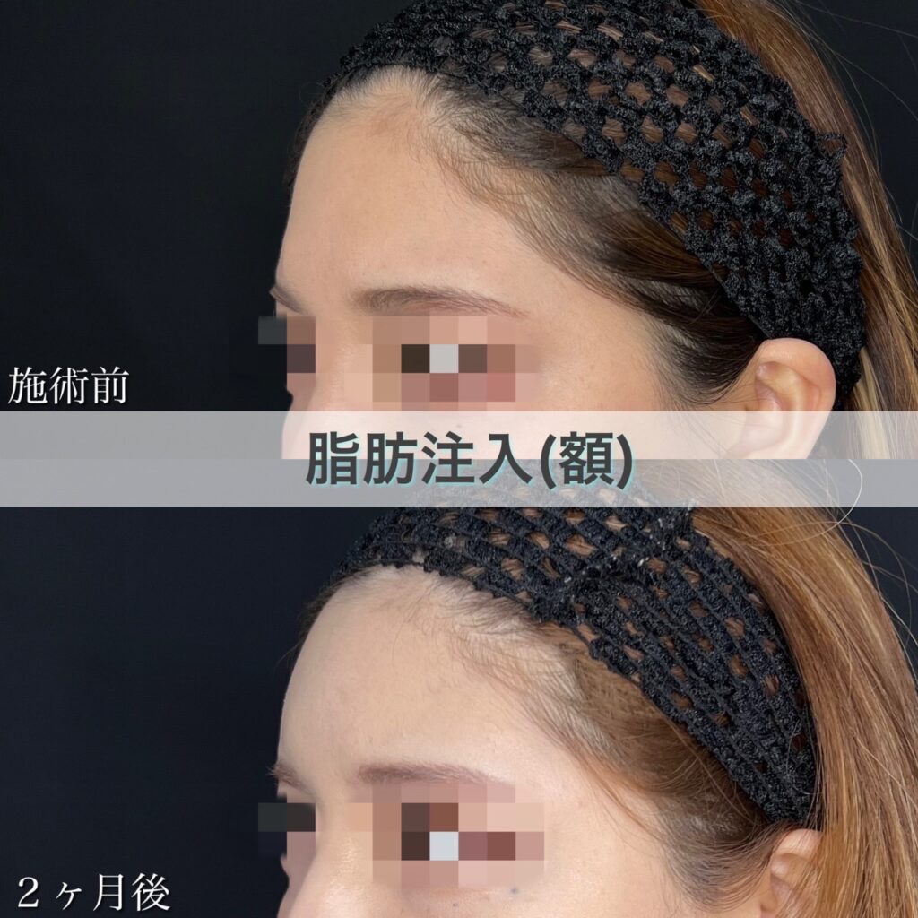 脂肪注入【額】