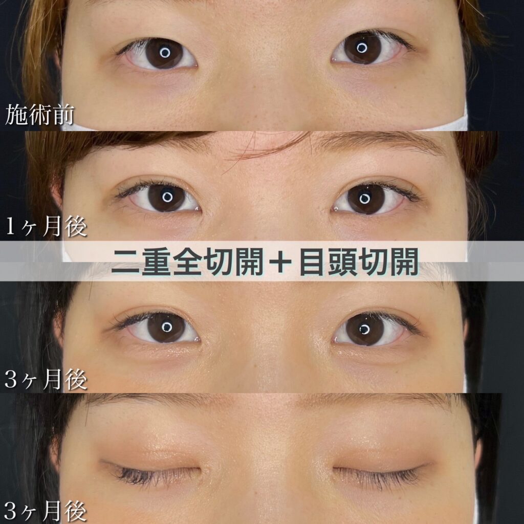 二重全切開＋目頭切開