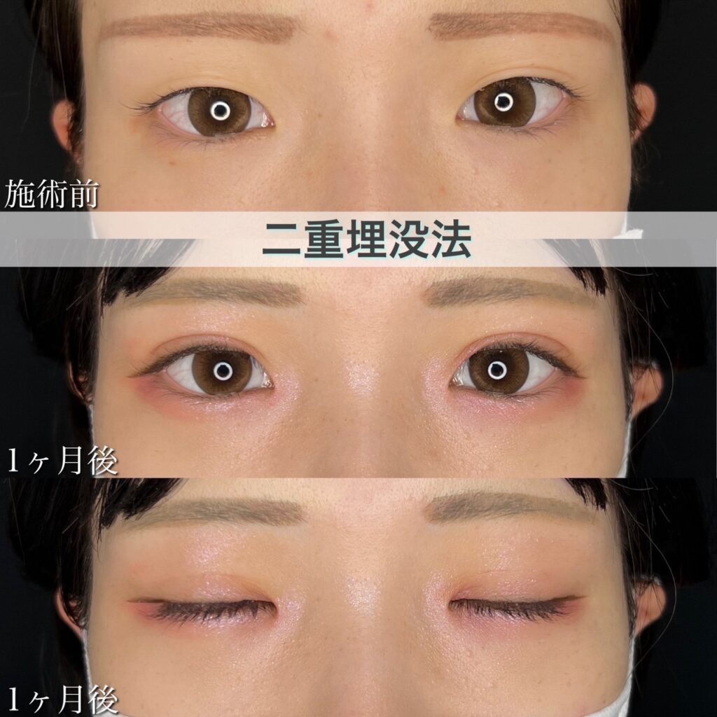 二重埋没法　自然癒着法の症例