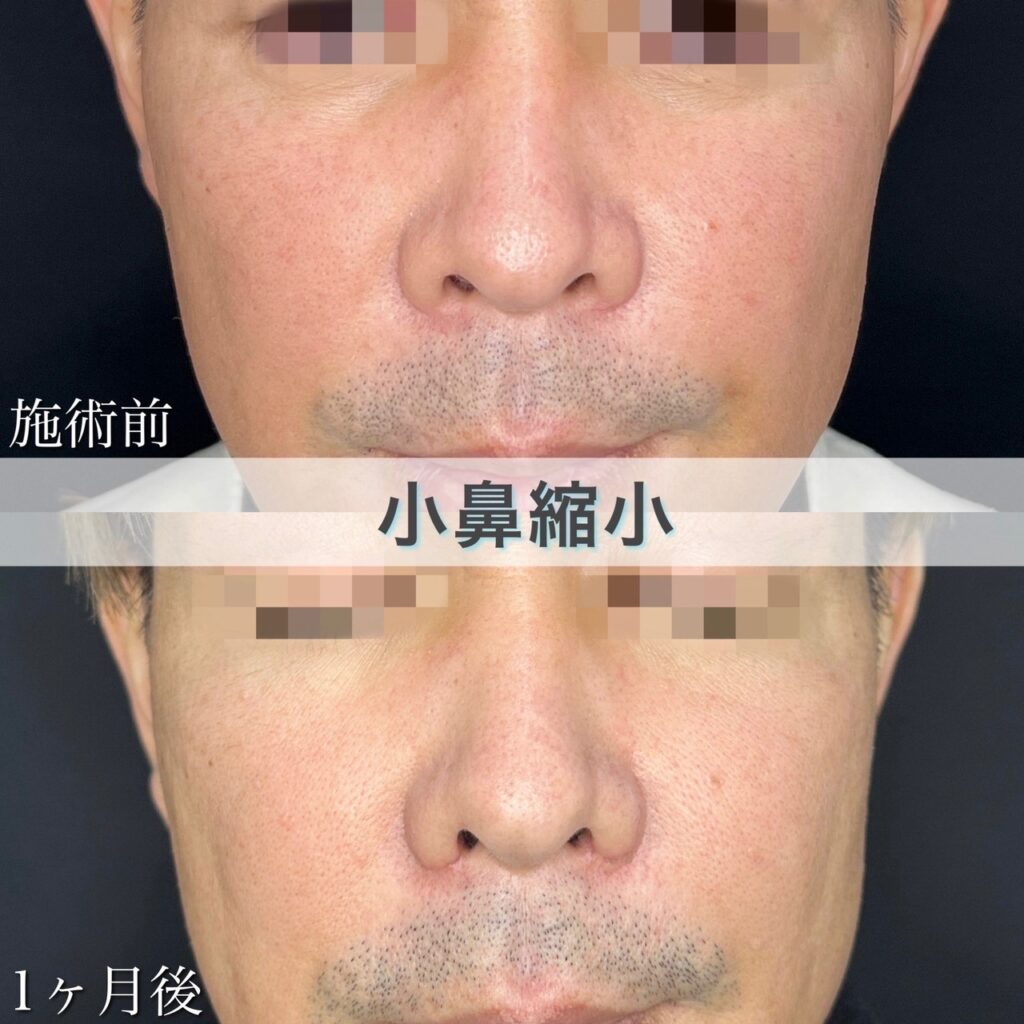 小鼻縮小
