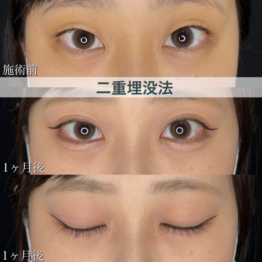 二重埋没法　自然癒着法の症例