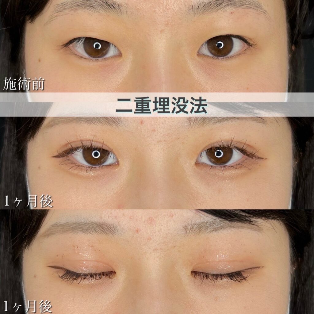 二重埋没法　自然癒着法の症例