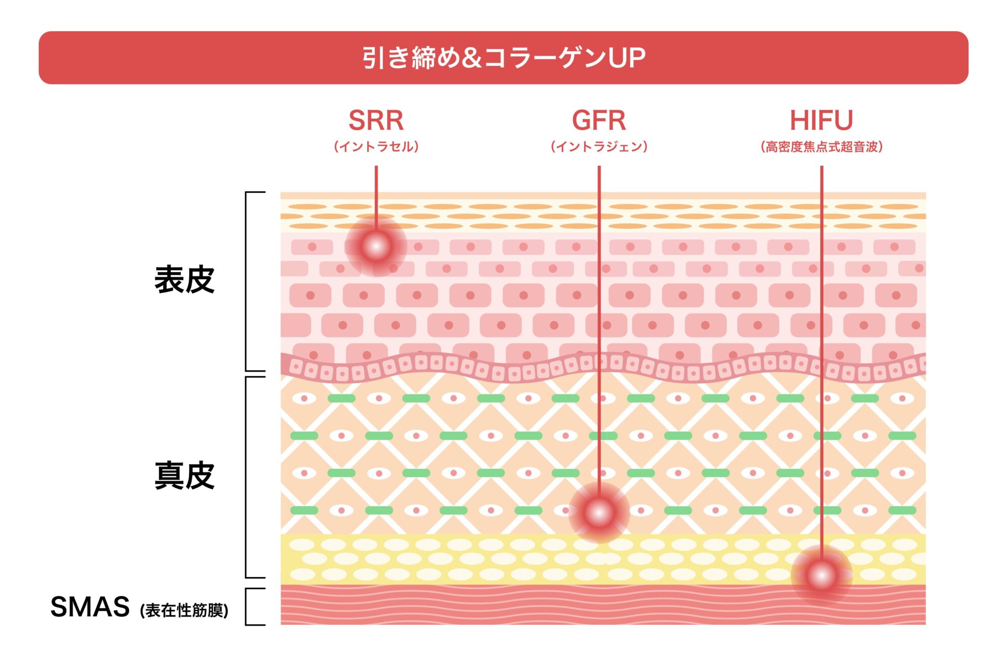 HIFU（ハイフ）とは？効果と仕組みを解説